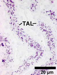 Ausbruch der „Dierks'schen Krankheit“: Die mikroskopische Aufnahme zeigt starke Anreiche-rungen von Heparansulfat (blau-rote Färbung) in Zellen vom Mittelstück der Nierenkanälchen (TAL). Schuld ist das fehlerhafte Enzym ARSG.